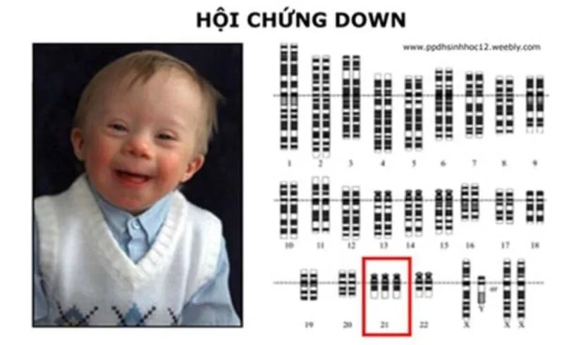 Hội chứng Down thường xảy ra do bất thường nhiễm sắc thể số 21 trong quá trình phân chia tế bào.