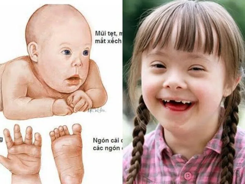 Trẻ mắc hội chứng Down có thể có một số đặc điểm thể chất và phát triển khác biệt, nhưng mức độ biểu hiện ở mỗi trẻ không giống nhau.